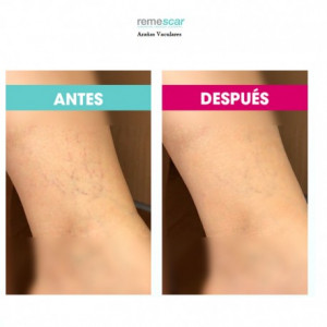 Remescar Varices Primor